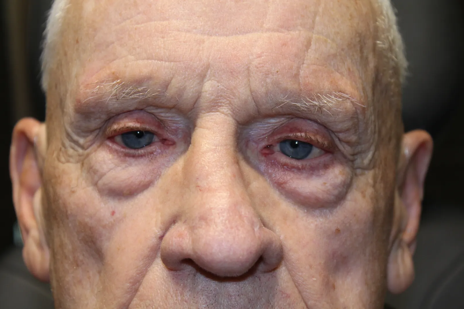 Before Ptosis Repair — patient photo