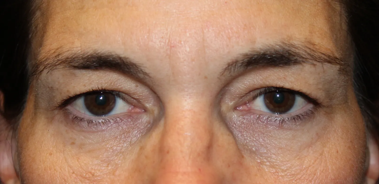 Before Upper Blepharoplasty — patient photo