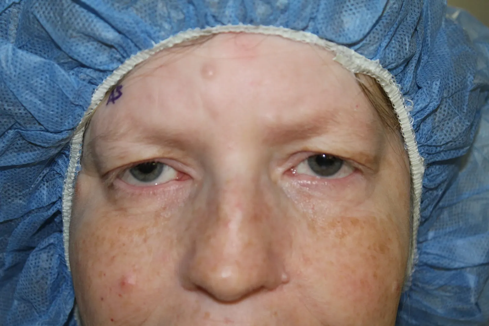 Before Lower Lid Retraction Repair — patient photo