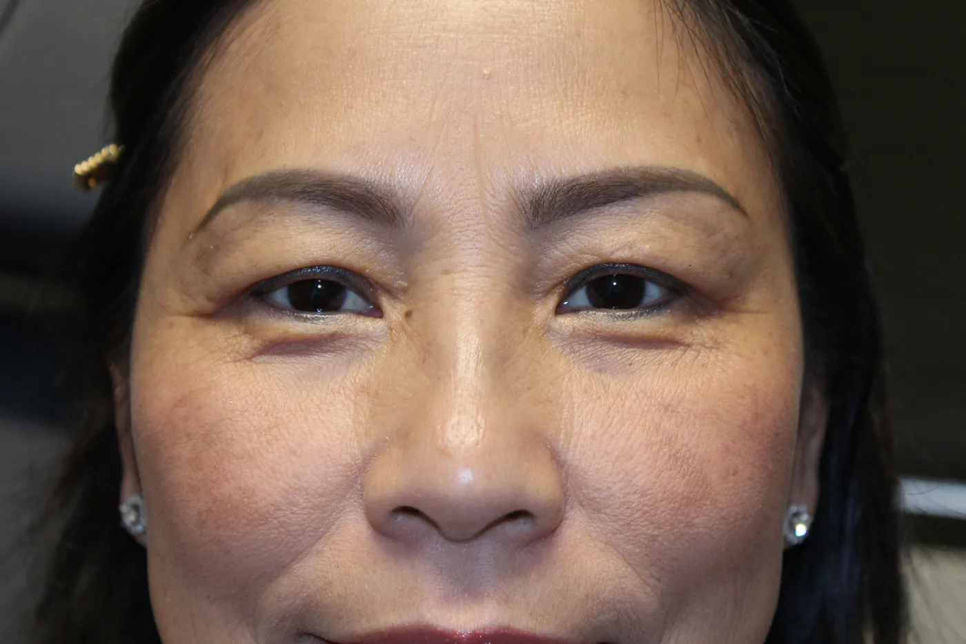 After Upper Blepharoplasty — patient photo