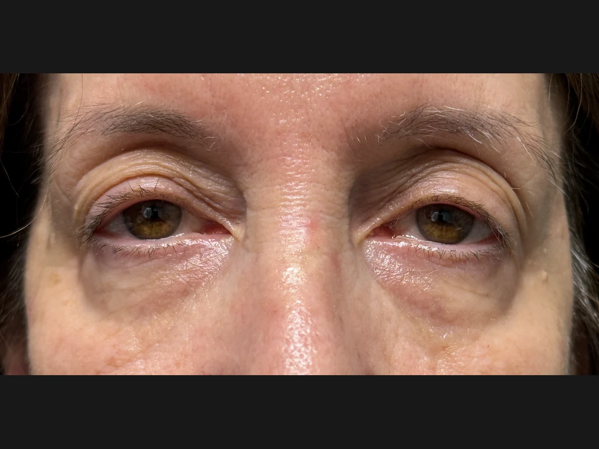 Before Upper Blepharoplasty · Ptosis Repair · Lower Blepharoplasty — patient of Dr. Ahmed Sheikh, Morristown NJ