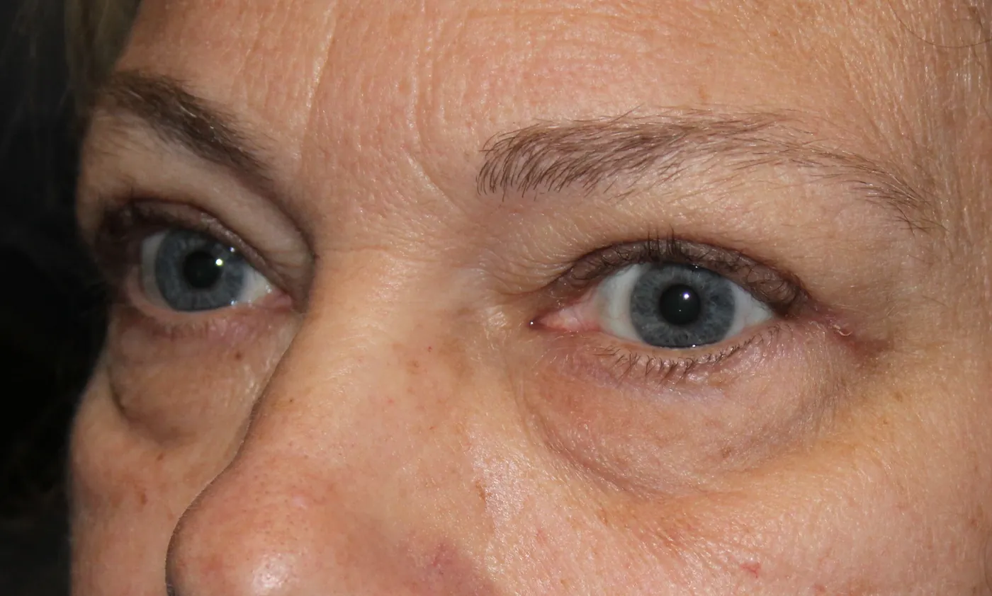 After Upper Blepharoplasty — patient photo