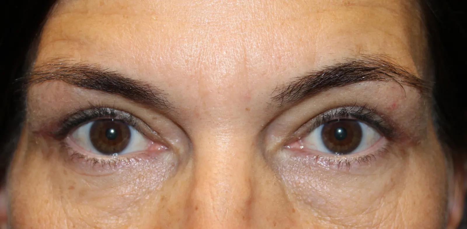 After Upper Blepharoplasty — patient photo