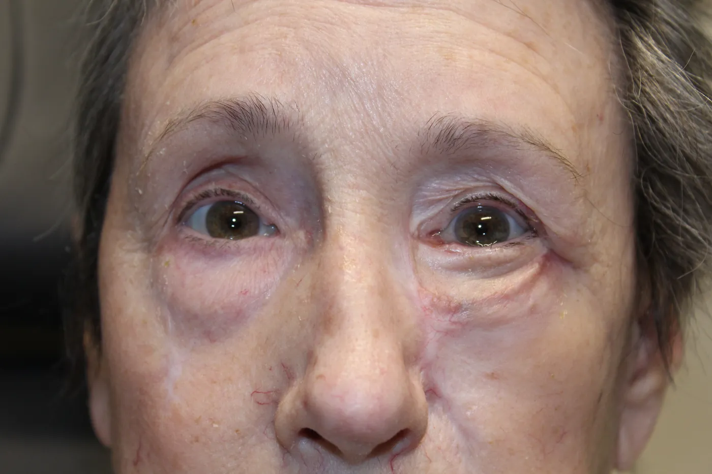 After Left Lower Eyelid Reconstruction — patient photo