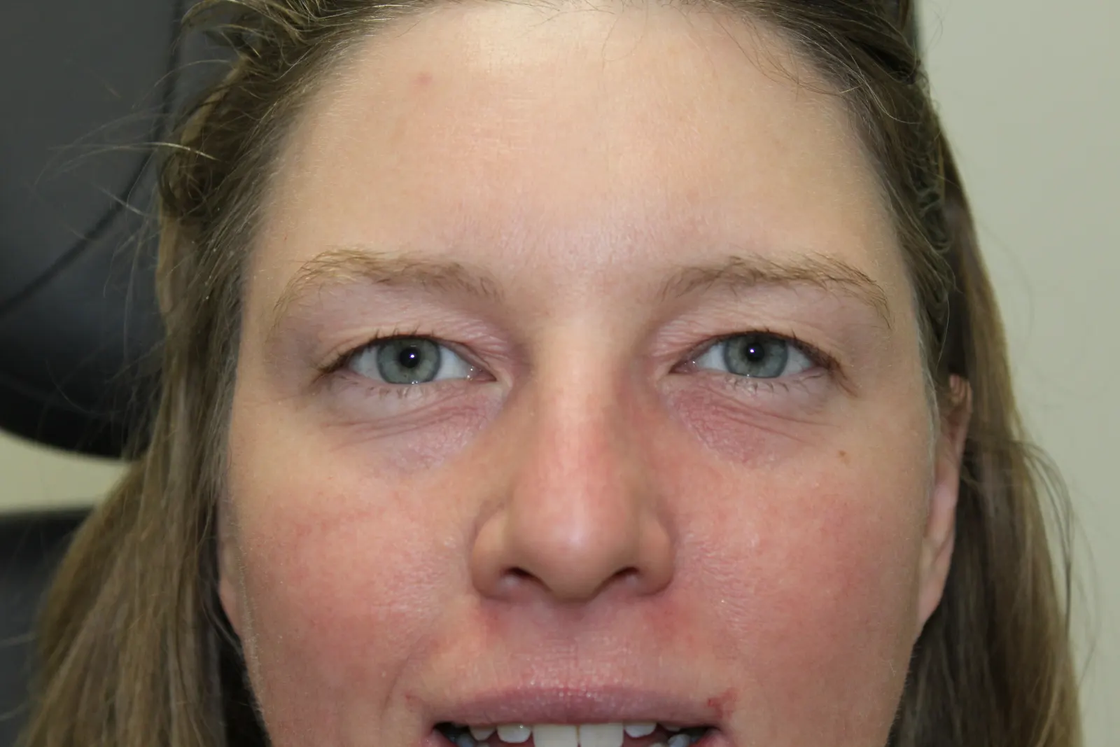 Before Upper Blepharoplasty — patient photo