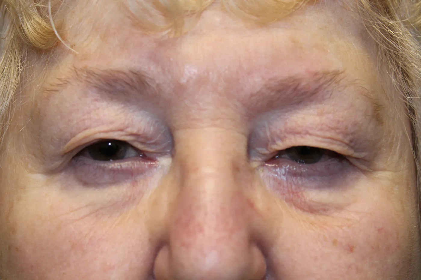 Before Upper Blepharoplasty · Ptosis Repair — patient photo