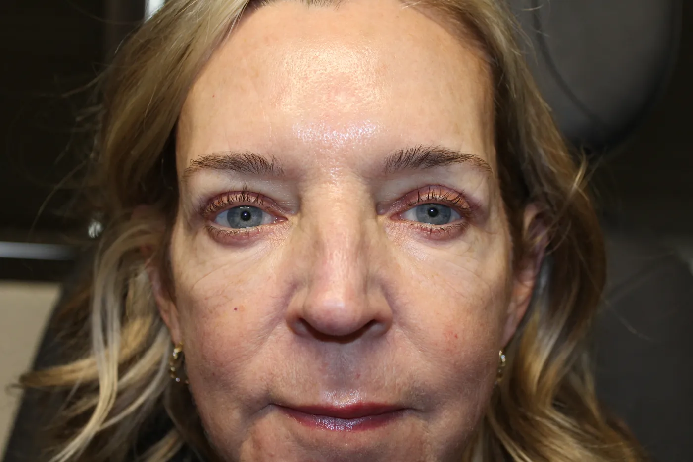 After Upper Blepharoplasty · Doxycycline Injection to Lower Eyelid Festoons — patient photo