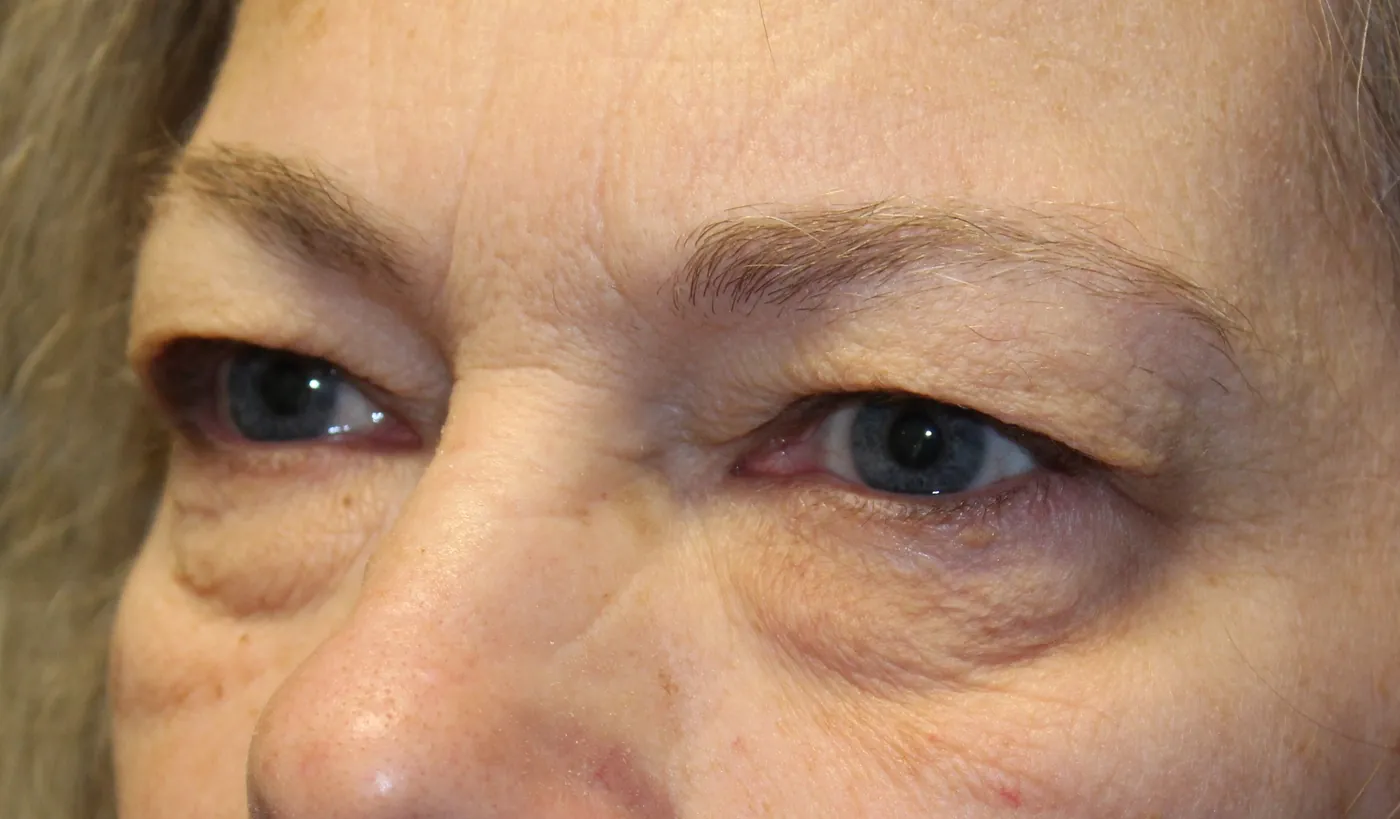 Before Upper Blepharoplasty — patient photo