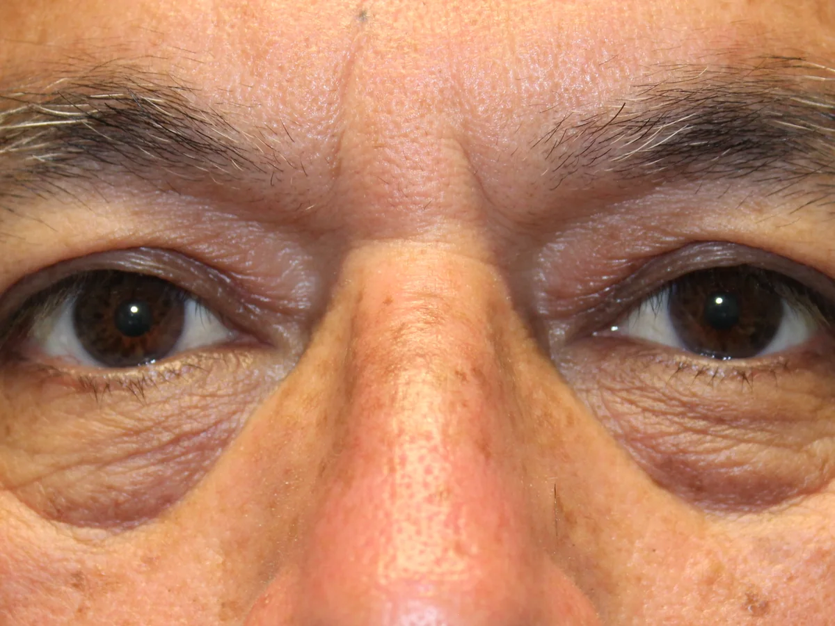 After Upper Blepharoplasty — patient of Dr. Ahmed Sheikh, Morristown NJ