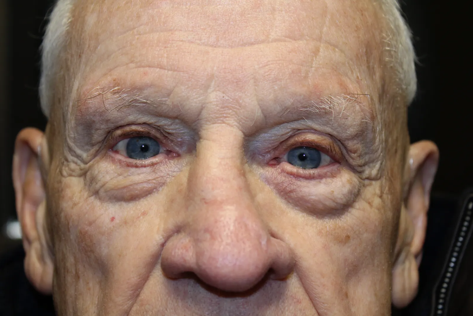 After Ptosis Repair — patient photo