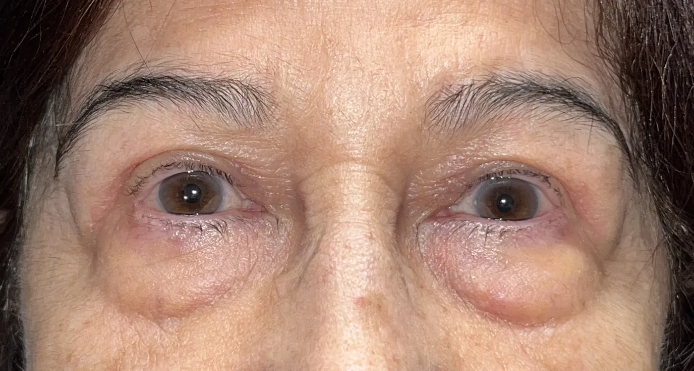 After Upper Blepharoplasty · Ptosis Repair — patient photo