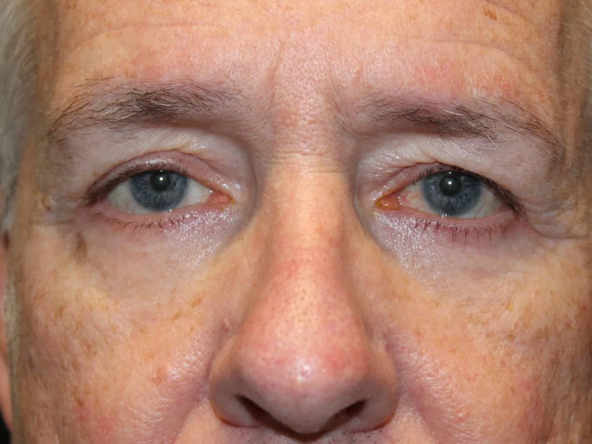 After Lower Blepharoplasty · Left Ptosis Repair — patient photo