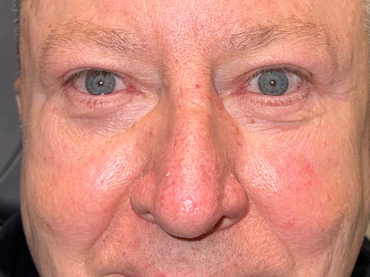 After Brow Lift · Lower Blepharoplasty — patient of Dr. Ahmed Sheikh, Morristown NJ