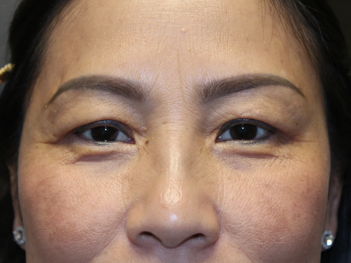 After Upper Blepharoplasty — patient of Dr. Ahmed Sheikh, Morristown NJ
