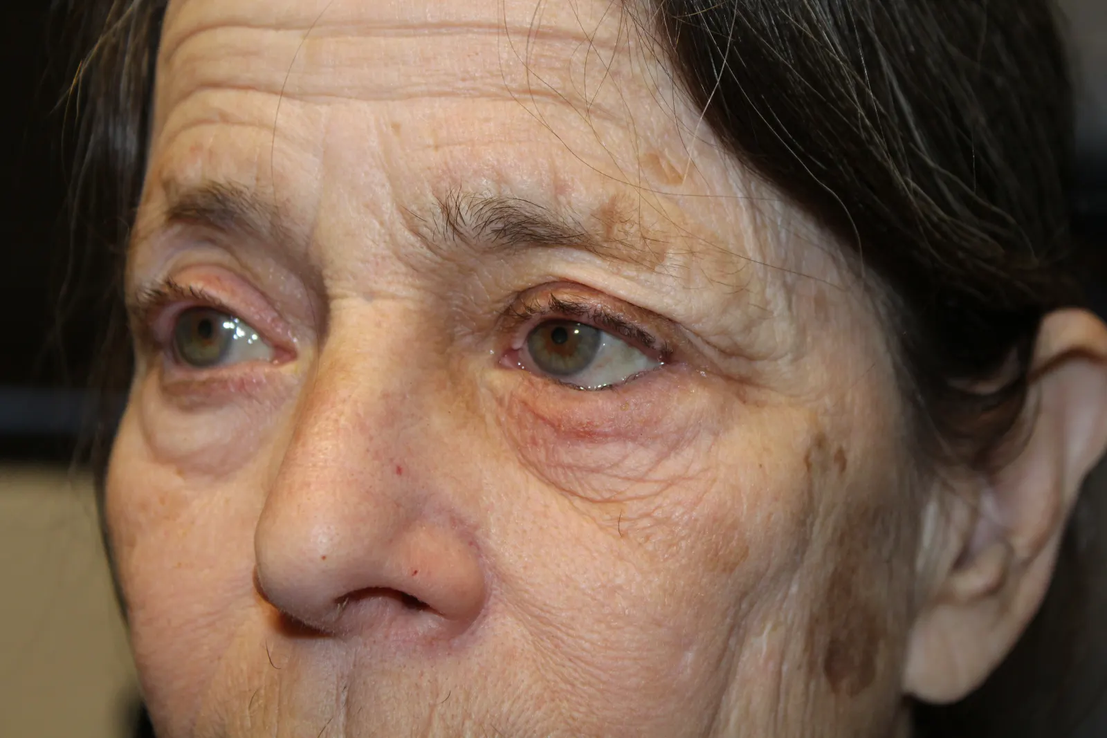 Before Left Lower Eyelid Entropion Repair — patient photo